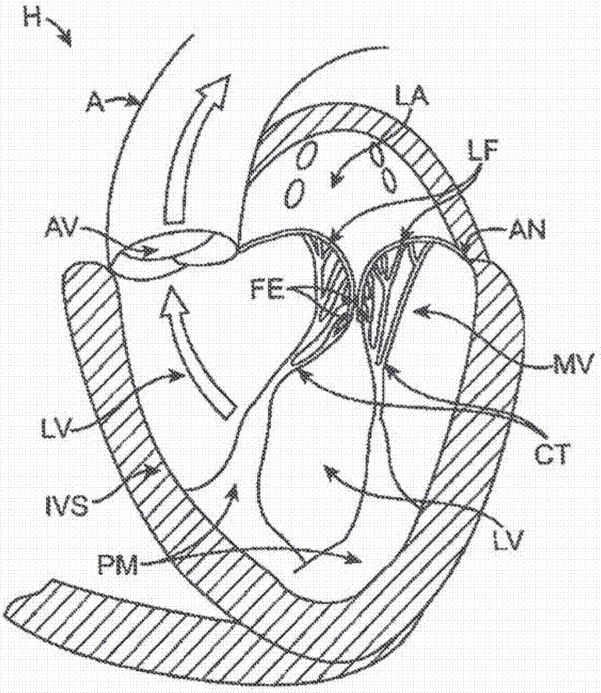 人工心脏瓣膜装置及相关系统和方法与流程