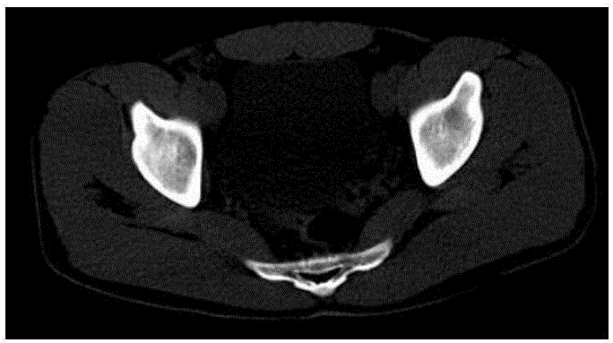 基于关键帧标记的序列CT图像骨盆轮廓快速提取方法与流程