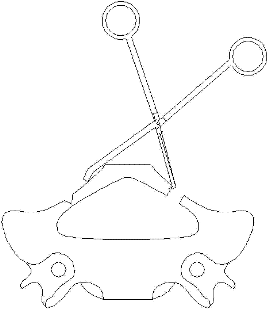 一種頸椎單開門手術(shù)椎板旋轉(zhuǎn)掀開器的制作方法與工藝