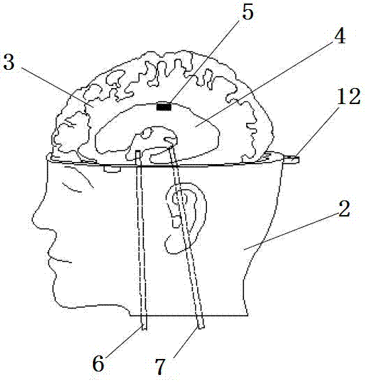 一种侧脑室穿刺手术演练装置及其使用方法与流程