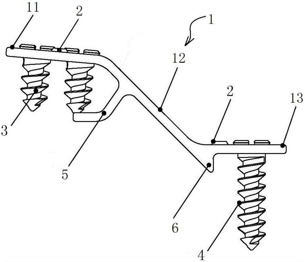 脊柱椎板桥接系统的制作方法与工艺