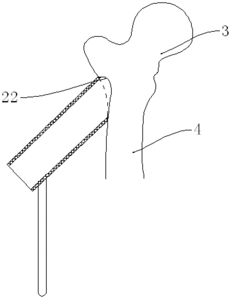 股骨頸螺釘工作套筒的制作方法與工藝