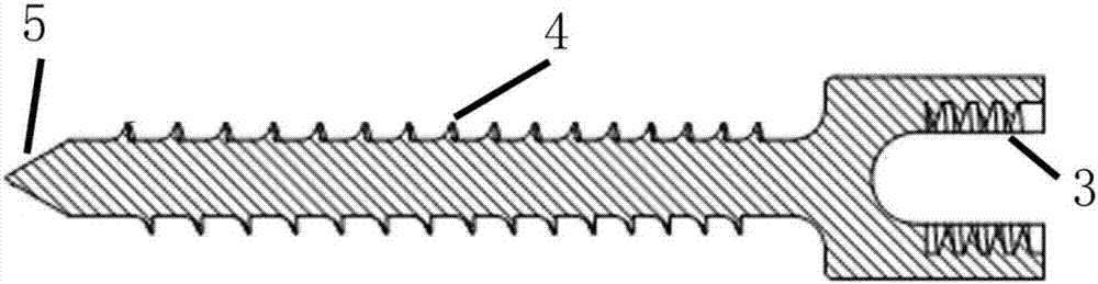 一種椎弓根螺釘?shù)闹谱鞣椒ㄅc工藝
