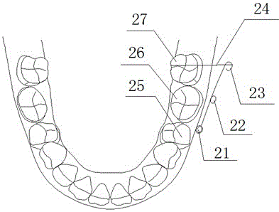 用于解除后牙正锁牙合的矫正器的制作方法与工艺