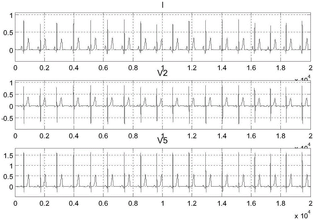 一种基于动态模式识别的心电信号ST‑T段识别方法与流程
