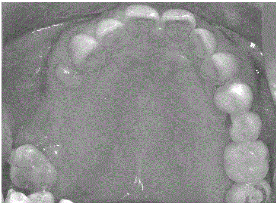 口腔修復(fù)體CAD/CAM/SLM?3D打印復(fù)合方法與流程