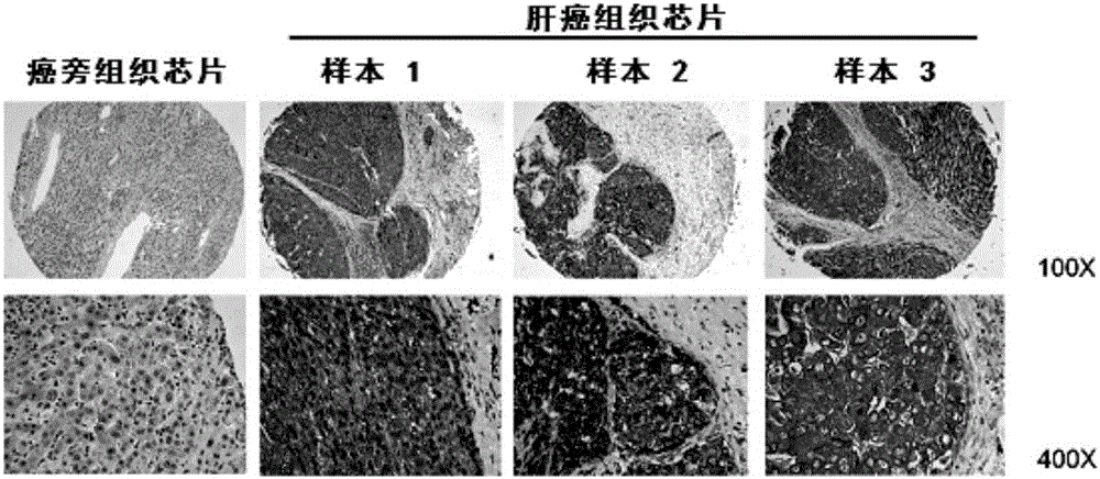 CHKA蛋白在制备肝癌预后评估试剂盒中的应用、试剂盒及方法与流程