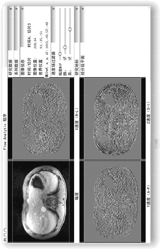 使用體相位對比MRI的全面的心血管分析的制作方法與工藝