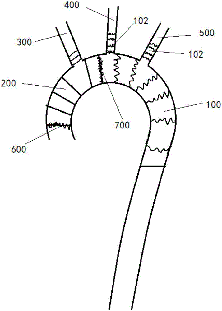 Stanford A型主動(dòng)脈夾層人工血管支架的制作方法與工藝