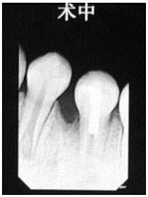 一种牙髓消炎糊剂及其制备方法与流程