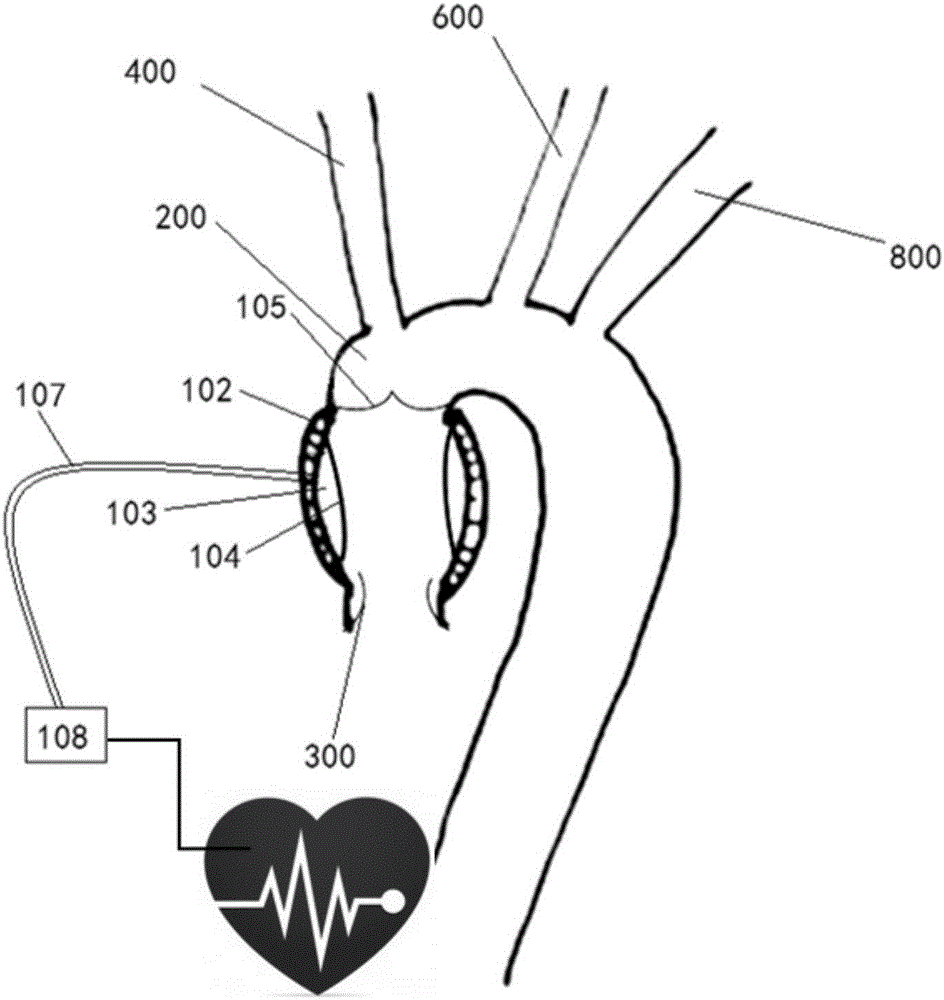 升主动脉型心室辅助装置的制作方法