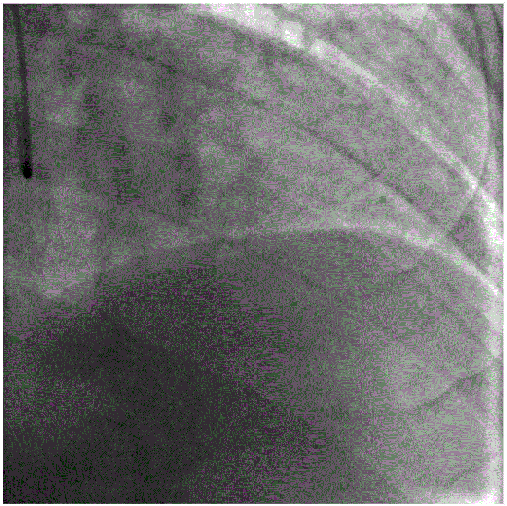 基于X射線冠脈造影圖像的冠狀動脈血流儲備分數(shù)計算方法與流程