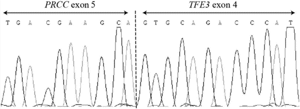 一种用于诊断PRCC‑TFE3易位性肿瘤的PCR引物组合及其应用的制作方法与工艺