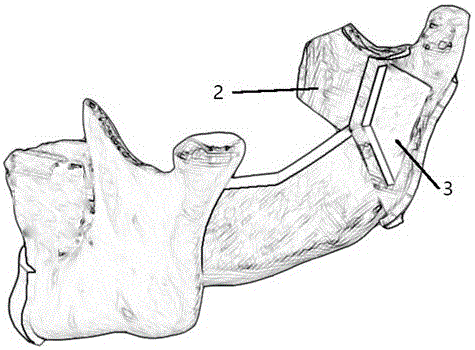 一種下頜骨手術(shù)鈦板?截骨導(dǎo)板空間位置的快速轉(zhuǎn)換方法與流程
