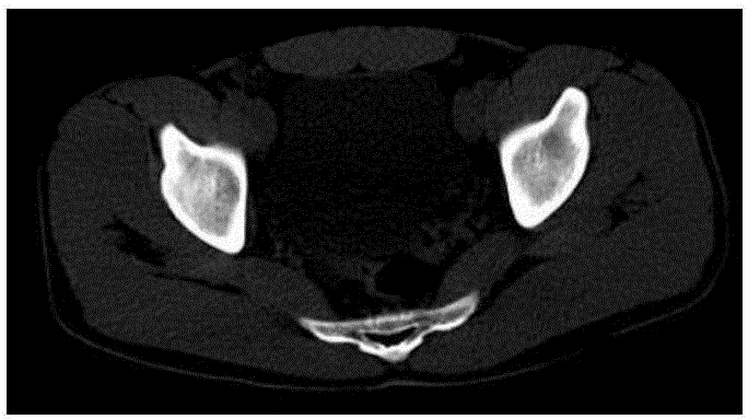 一种CT骨盆图像的关键帧提取方法与流程