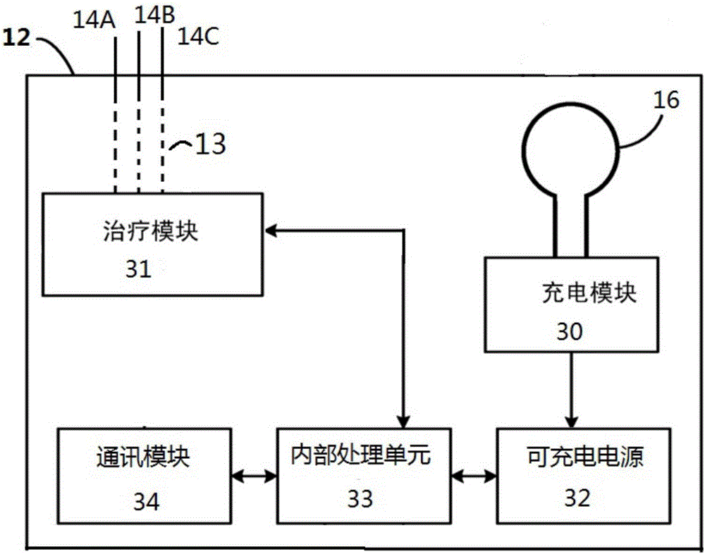 一種骶神經(jīng)刺激裝置的充電裝置的制作方法