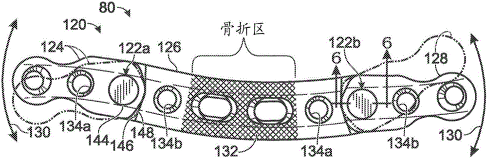 具有可移动关节的骨板的制作方法与工艺