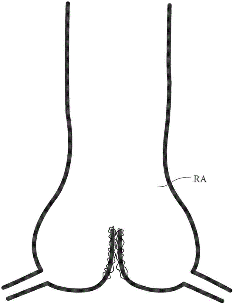 用于經(jīng)導(dǎo)管插入到竇管交界處的主動脈根部的設(shè)備的制作方法與工藝