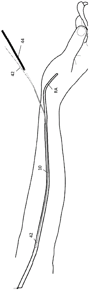 用于無護(hù)套經(jīng)橈動(dòng)脈導(dǎo)管插入的方法和裝置與流程