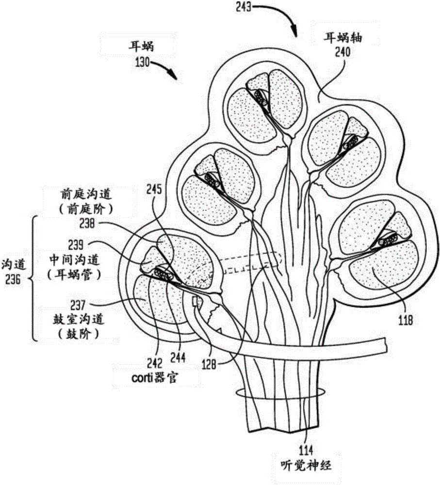 耳蜗内刺激组件插入的制作方法与工艺