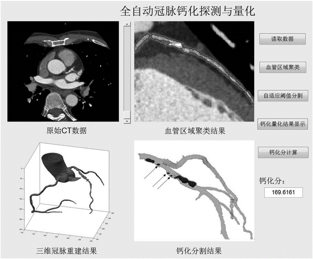 增強(qiáng)CT圖像中冠脈鈣化檢測(cè)及量化裝置和方法與流程