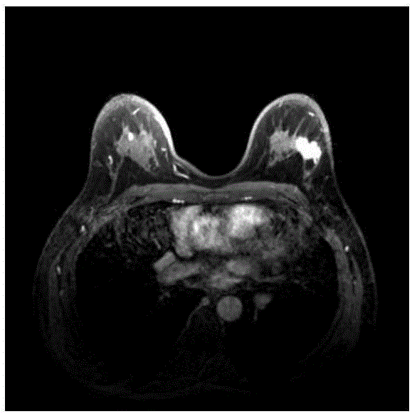 基于幀間相關(guān)性的乳腺M(fèi)RI病灶的自動(dòng)分割方法與流程