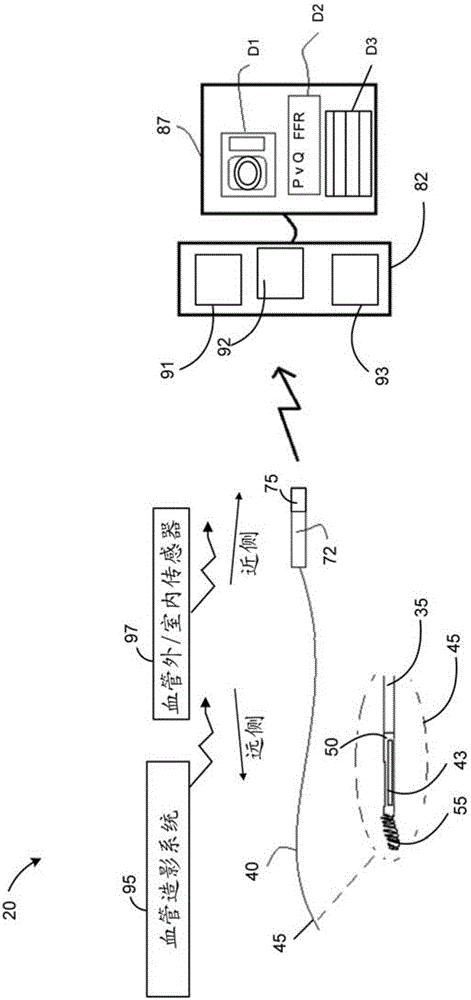 血管内压力和流量数据诊断系统、设备和方法与流程