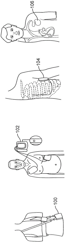 體外除顫器的制作方法與工藝