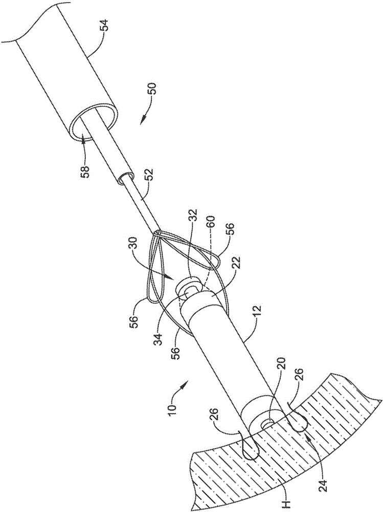 具有取回特征的无引线心脏起搏器的制作方法与工艺