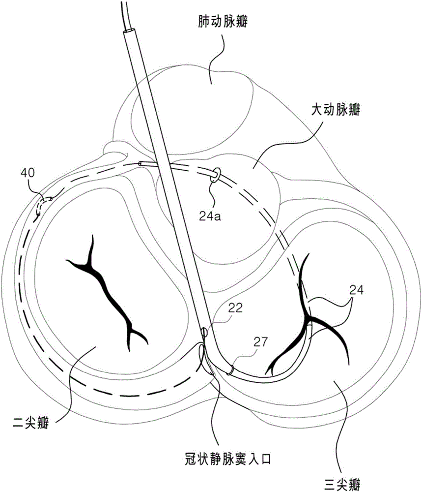 二尖瓣環(huán)扎手術(shù)所使用的組織保護器具的制作方法與工藝