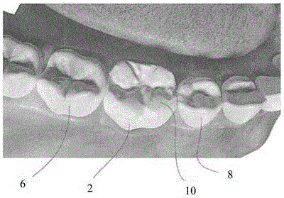 牙科修復(fù)裝置及其使用方法與流程