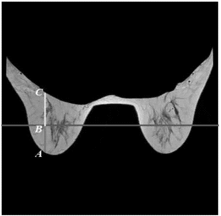 一种仰卧体位压迫乳房成像方法与流程