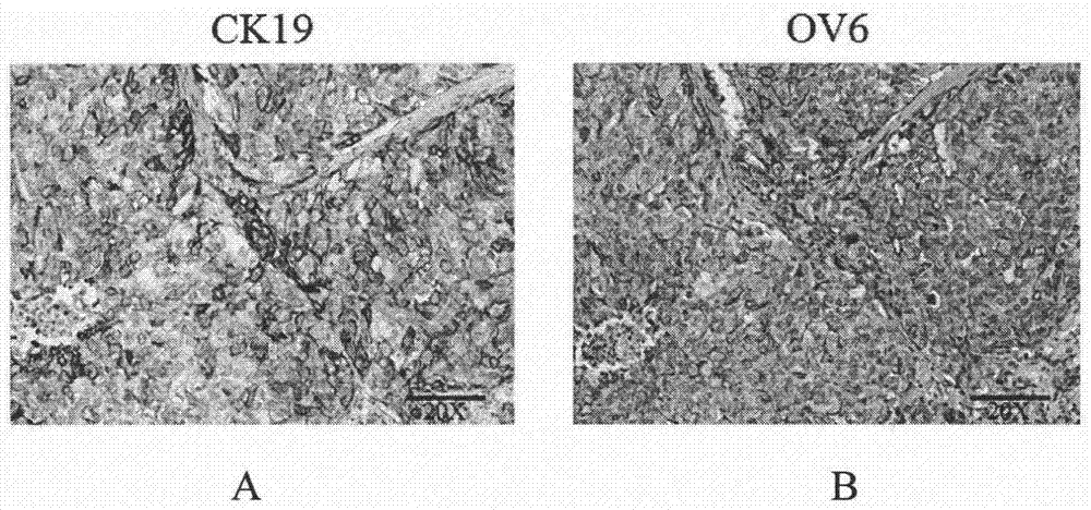 CK19聯(lián)合OV6在肝癌索拉菲尼精準治療中的應用的制造方法與工藝