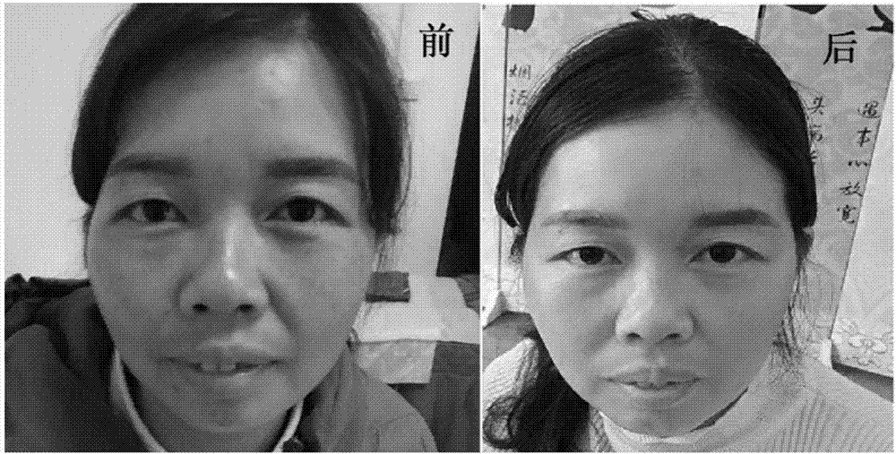一种祛痘祛斑组合物和一种祛痘祛斑面膜及其制备方法与流程
