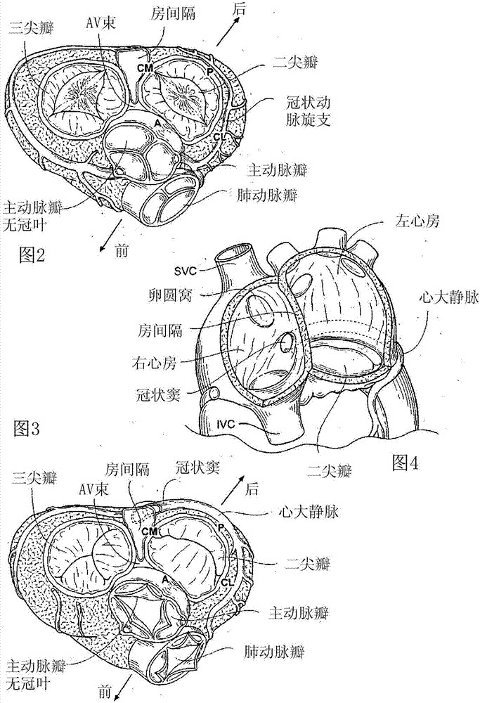 速卸瓣环成形术环支架的制造方法与工艺