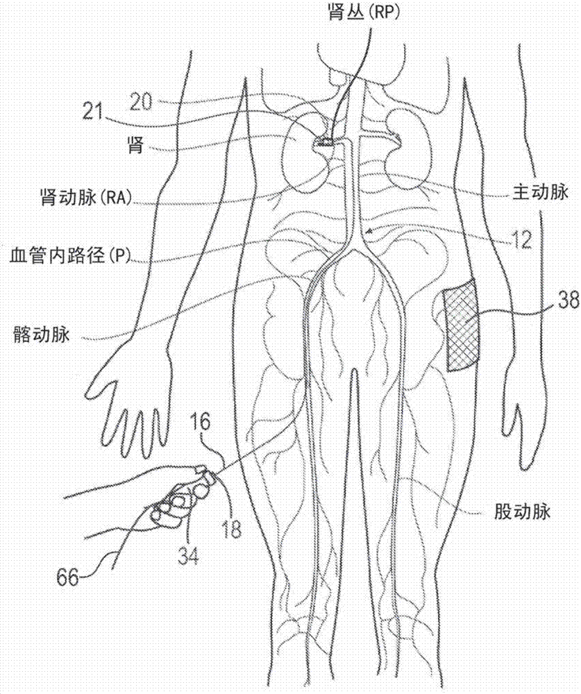 用于人類患者的處理的腎神經(jīng)調(diào)節(jié)系統(tǒng)的制造方法與工藝