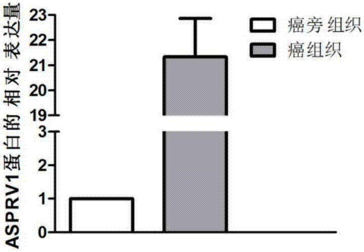 ASPRV1作為生物標(biāo)志物在喉鱗癌診療中的應(yīng)用的制造方法與工藝