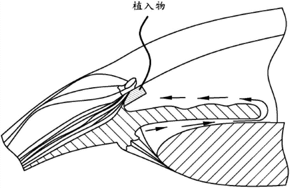 前房?jī)?nèi)持續(xù)釋放治療藥植入物的制造方法與工藝