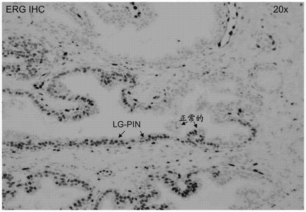 前列腺活組織檢查中低級(jí)PIN(LG?PIN)中ERG基因重排和蛋白質(zhì)過(guò)表達(dá)的存在的制造方法與工藝
