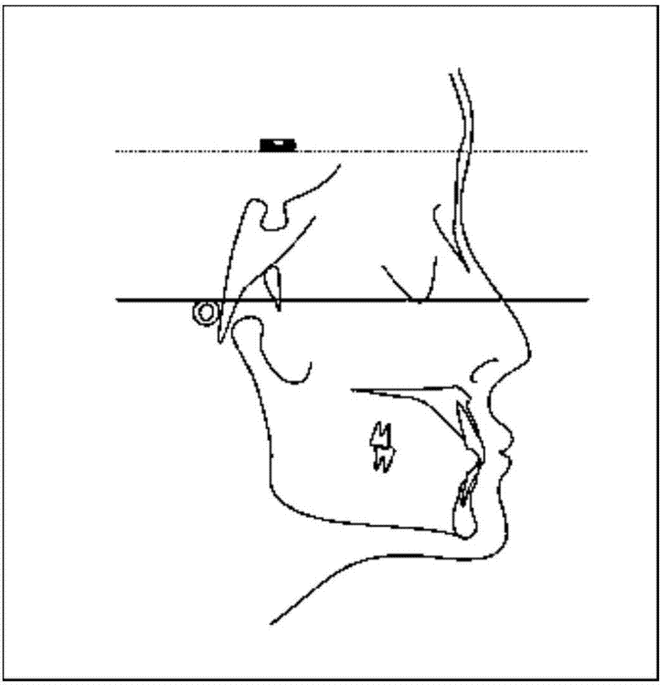 一种头颅正侧位片拍摄辅助定位头带的制造方法与工艺