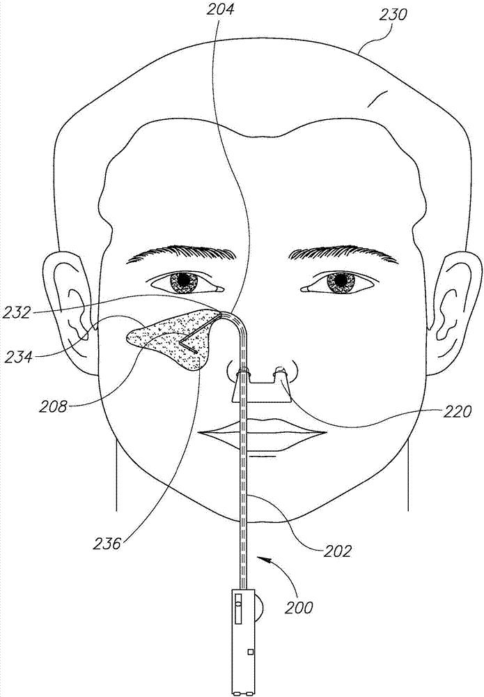 鼻旁窦医疗装置及其用途的制造方法