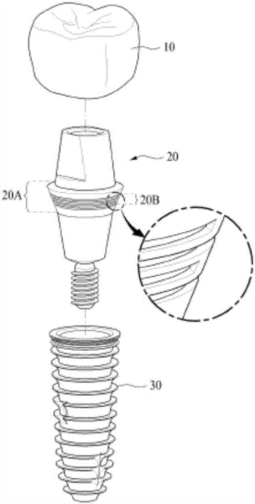 牙科植入體及其制造方法與流程