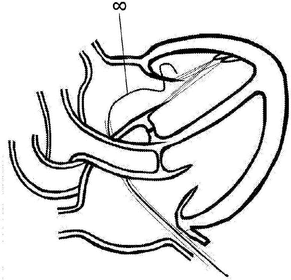 用于微創(chuàng)瓣膜程序的低剖面經(jīng)中隔導(dǎo)管和植入系統(tǒng)的制造方法與工藝