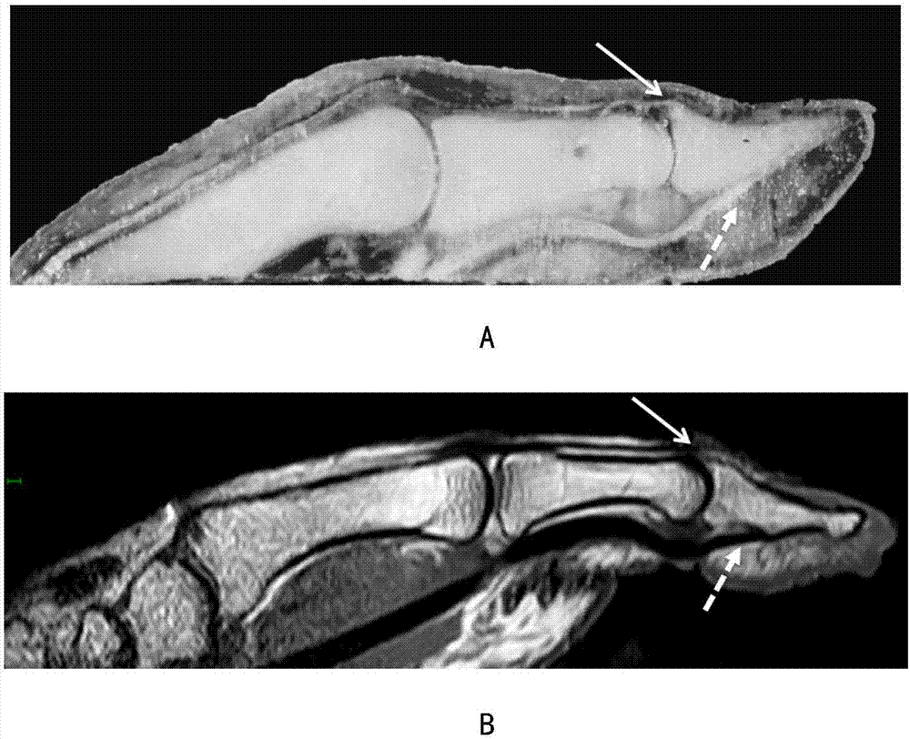 基于MR圖像的手指損傷檢測(cè)方法及系統(tǒng)與流程
