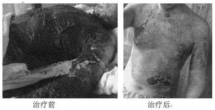 一種燒燙傷藥涂液及其制備方法和使用方法與流程