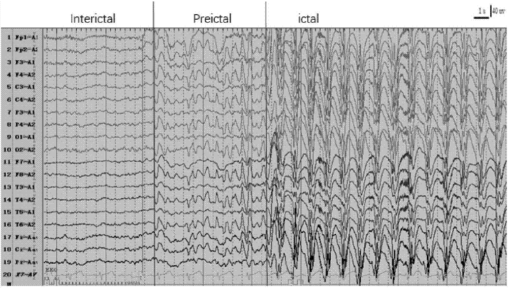 一种癫痫患者脑电信号的处理方法及系统与流程