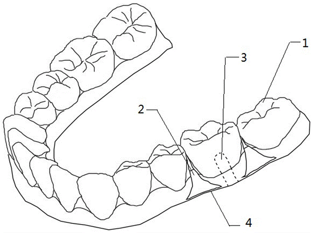 測量矯治器對牙齒施力的模型的制造方法與工藝