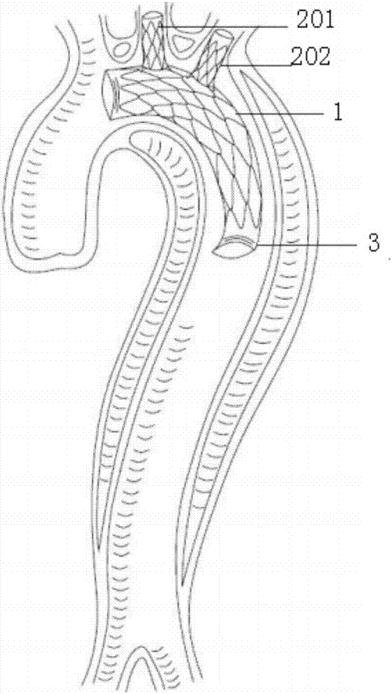 一种带分支支架血管的主动脉弓直视支架血管的制作