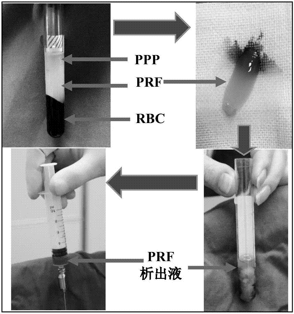 一种基于纳米脂肪基质细胞修复再生注射物的制备方法