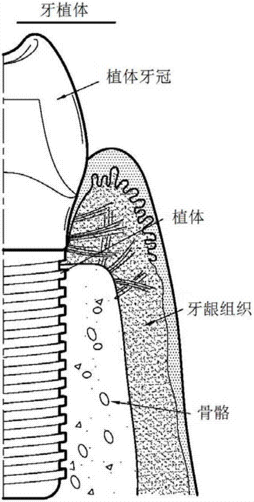 超聲儀器的超聲尖頭和使用所述超聲尖頭的牙科處理方法與流程